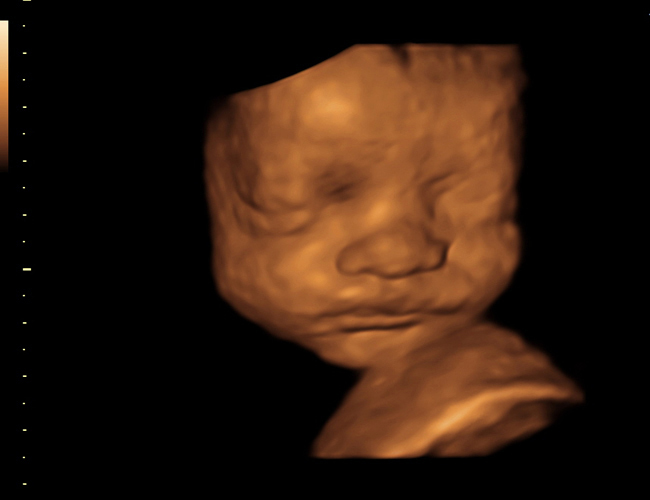3D ultrasound image at 29 weeks